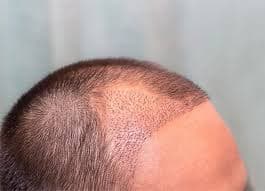Haartransplantation Türkei Kosten: The Key to Unlocking Confidence