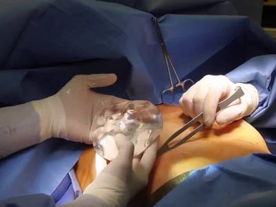 Wie Autoaugmentation und Bruststraffung eine natürliche Brustästhetik ohne Silikon ermöglichen
