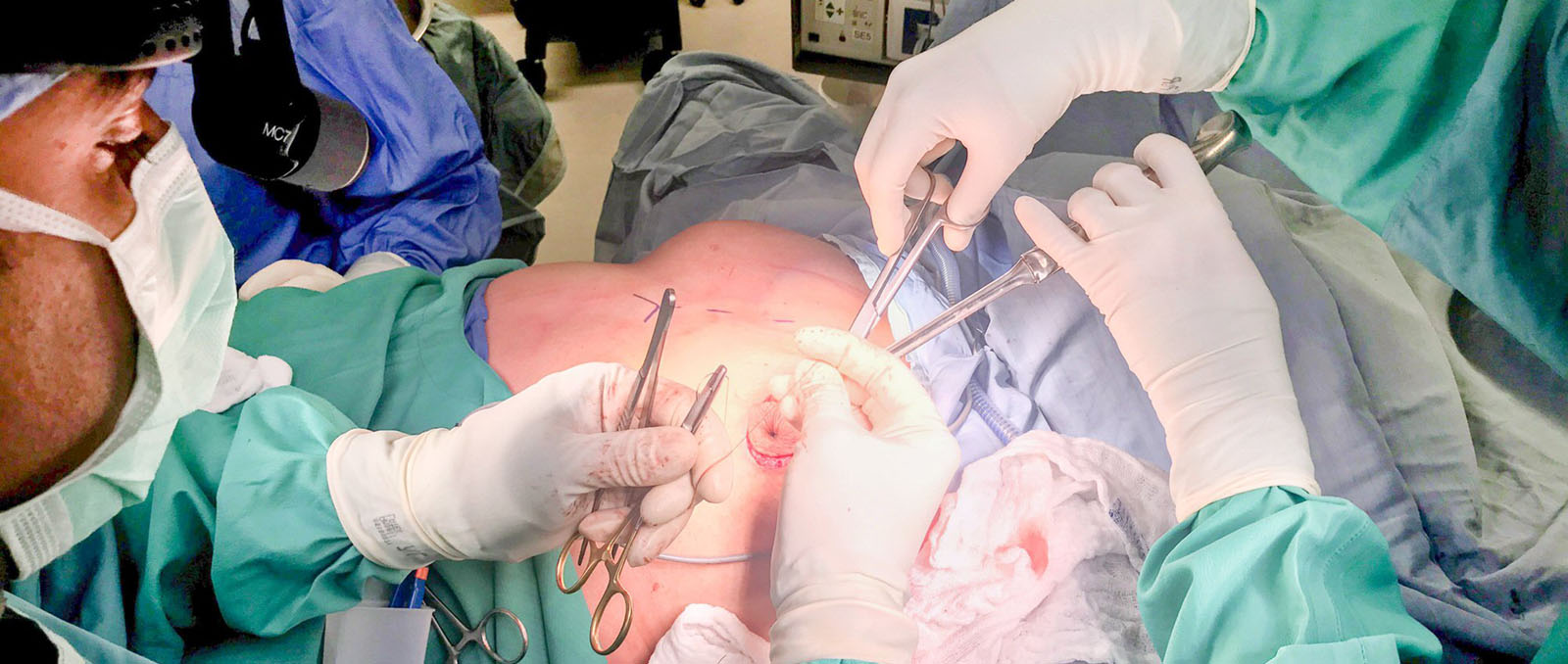 Bruststraffung ohne Implantate: Warum die Autoaugmentation eine effektive Lösung ist
